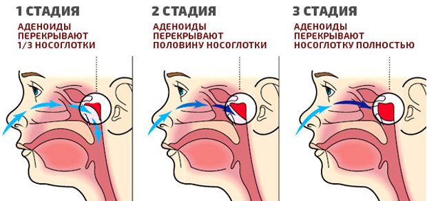 Лечение аденоидов методом рассасывания без операции у детей