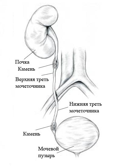 Камень левого мочеточника. Конкремент верхней трети правого мочеточника. Конкремент верхней трети левого мочеточника. Конкремент нижней 3 мочеточника. Конкремент нижней трети левого мочеточника.