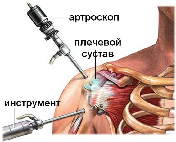 Лечение остеохондроза шейного отдела позвоночника