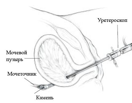 Сколько стоит операция по удалению камней