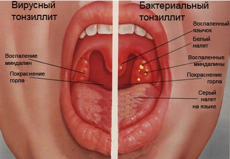 Как Выглядит Ангина Фото