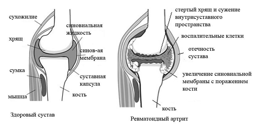 ревматоидный артрит симптомы лечение отзывы