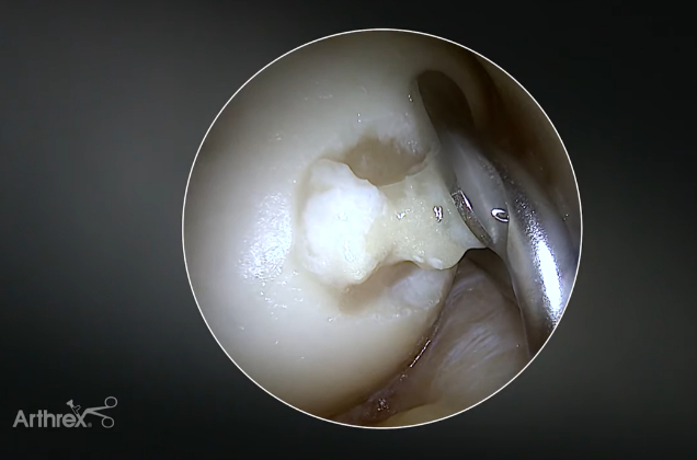Мастер-класс для травматологов-ортопедов: Пластика хряща методом AutoCart™