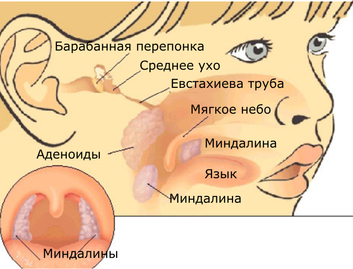 Медикаментозное лечение воспаления аденоидов у ребенка