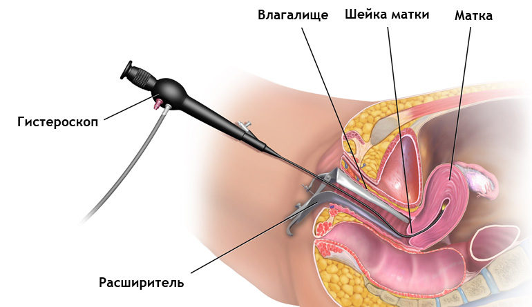 ​Когда проводится гистерорезекция при полипе эндометрия?