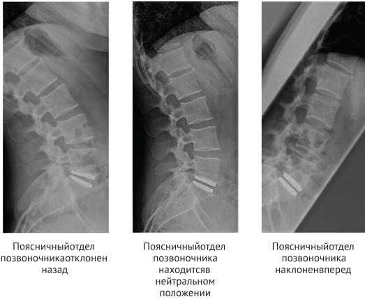 Операция по замене межпозвоночного диска